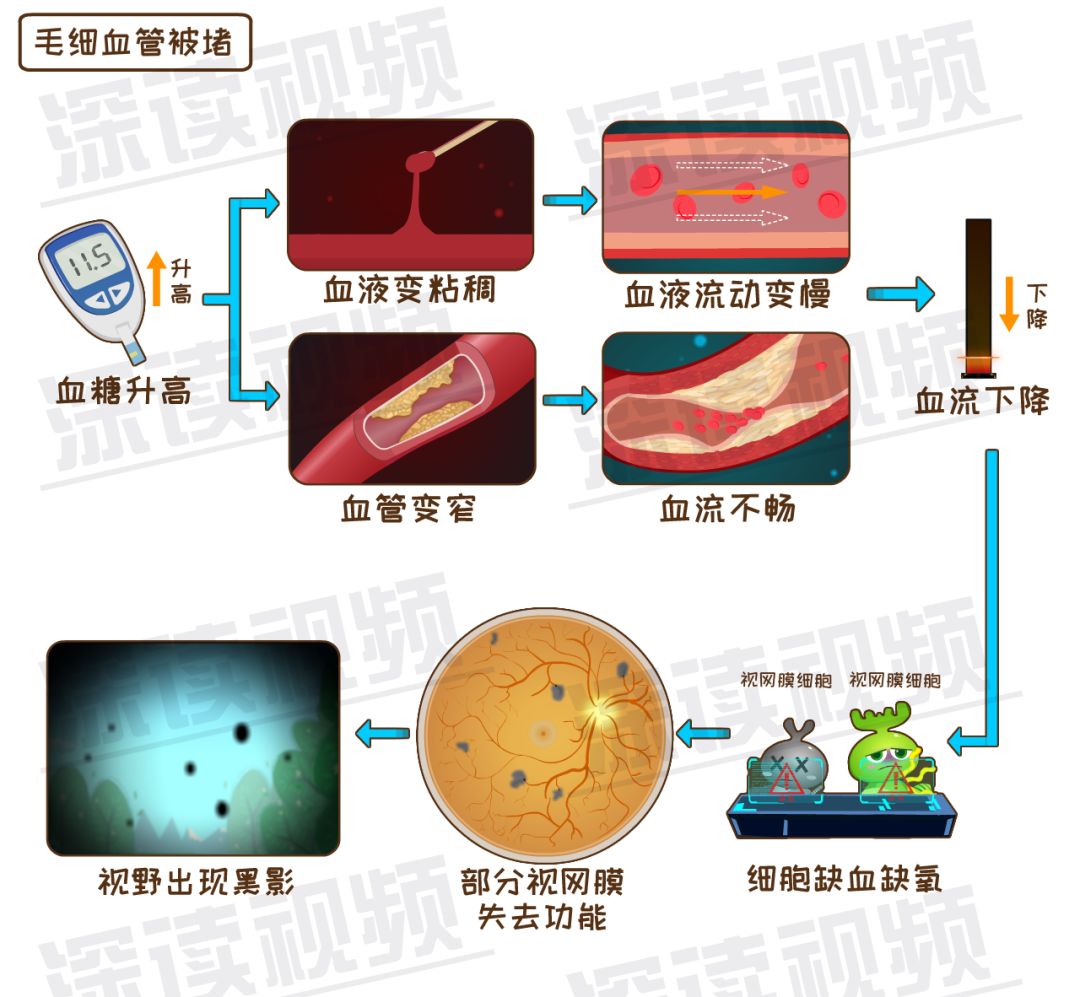 糖友控糖不利，视网膜会脱落？不痛不痒就瞎了？动漫解析致盲细节